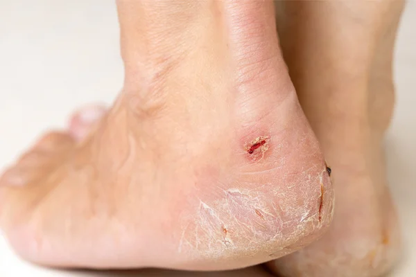 Plecy kobiety z oznakami poparzenia słonecznego.